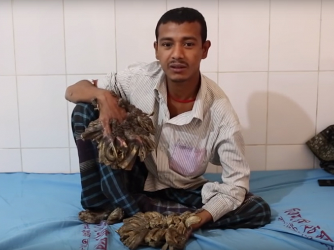Abdul Bajandra iz Bangladeša, poznatiji kao "Čovjek-drvo" - Foto: Screenshot/YouTube